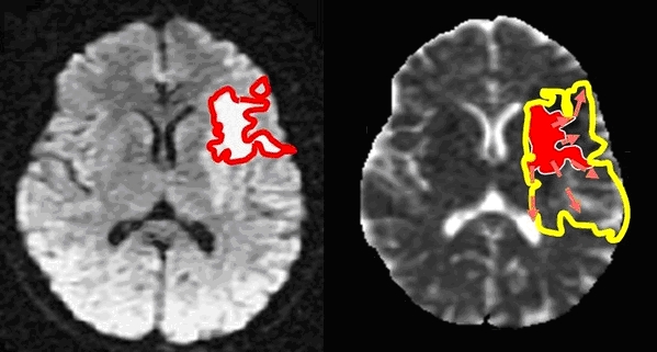 Neurinfarct